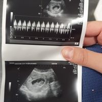 Ayuda con método ramzi: niño o niña? - 1