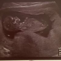 Ayuda con método ramzi: niño o niña? - 2