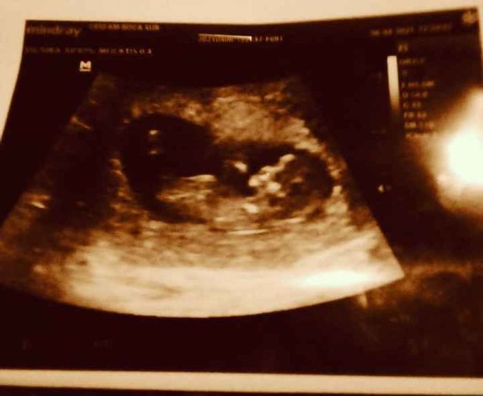 Ayuda con método ramzi: niño o niña? - 1