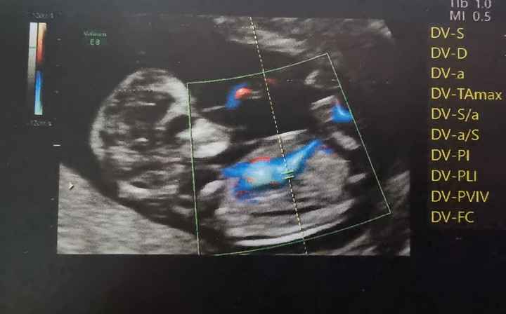 Que os parece? Niño o niña? - 1