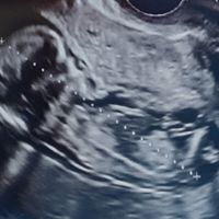 Tubérculo genital: niña - 1
