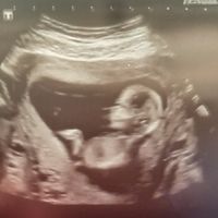 Tubérculo genital: niña - 2