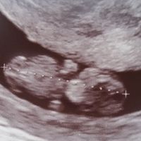Tubérculo genital: niña - 1