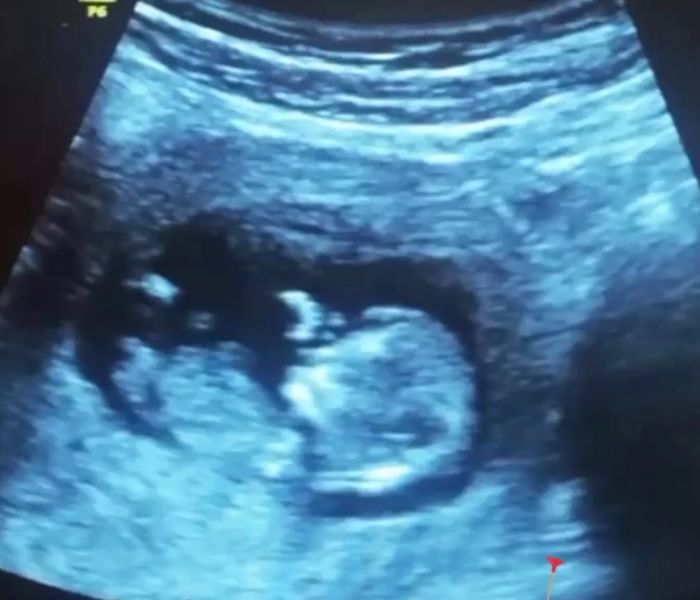 Ayuda con método ramzi: niño o niña? - 1