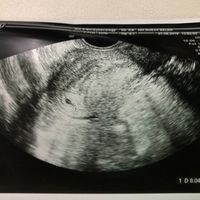 Ayuda con método ramzi: niño o niña? - 1