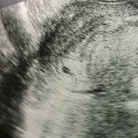 Ayuda con método ramzi: niño o niña? - 1