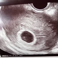 Ayuda con método ramzi: niño o niña? - 1