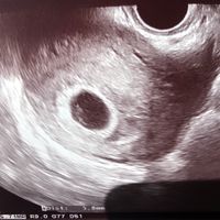 Ayuda con método ramzi: niño o niña? - 2