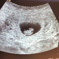 Ayuda con método ramzi: niño o niña? - 1