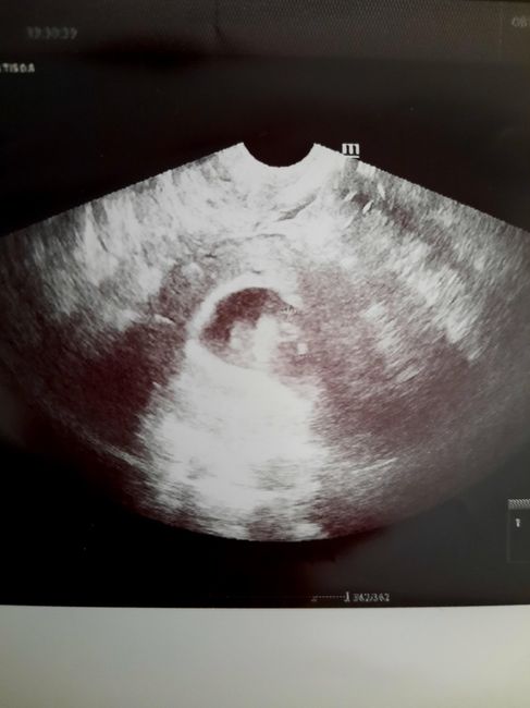 Ayuda con método ramzi: niño o niña? - 1