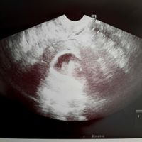Ayuda con método ramzi: niño o niña? - 1