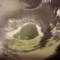 Ayuda con método ramzi: niño o niña? - 1