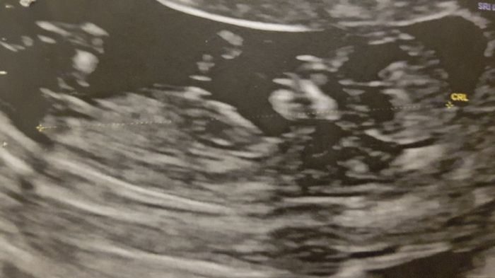 Tubérculo genital: niña - 1