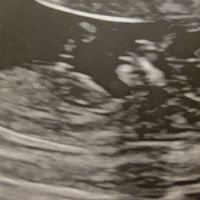 Tubérculo genital: niña - 1