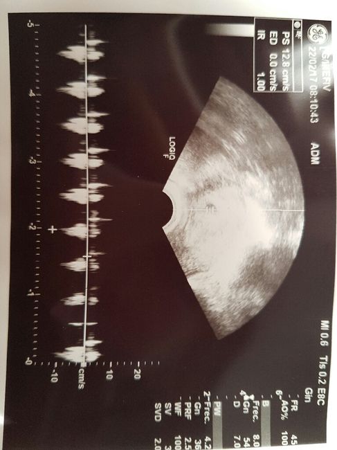 Buscadoras después de uno o varios abortos ii - 1