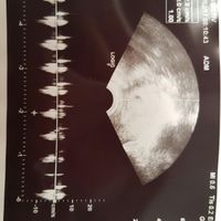 Buscadoras después de uno o varios abortos ii - 1