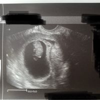 Ayuda con método ramzi: niño o niña? - 1