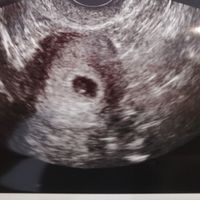 Ayuda con método ramzi: niño o niña? - 1