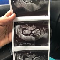 12+5 probable niño? - 1