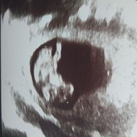 Ayuda con método ramzi: niño o niña? - 2