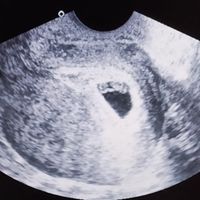 Ayuda con método ramzi: niño o niña? - 1