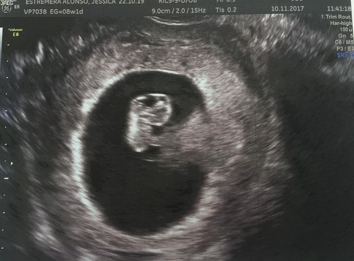 Ayuda con método ramzi niño o niña? Futuras Mamás Foro