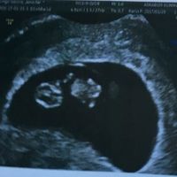 Ayuda con método ramzi: niño o niña? - 1
