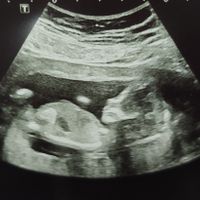 Ayuda con método ramzi: niño o niña? - 1