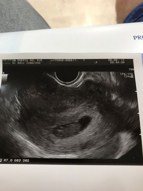 Buscadoras después de uno o varios abortos ii - 1
