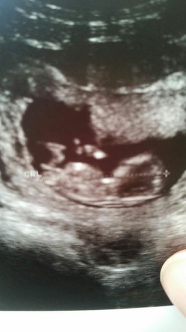 Ayuda con método ramzi: niño o niña? - 1