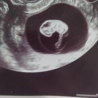 Ayuda con método ramzi: niño o niña? - 1