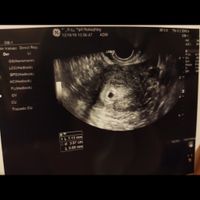 Ayuda con método ramzi: niño o niña? - 1
