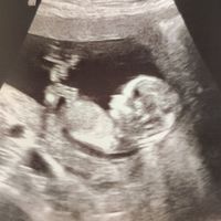 Ayuda con método ramzi: niño o niña? - 2