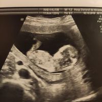 Ayuda con método ramzi: niño o niña? - 1