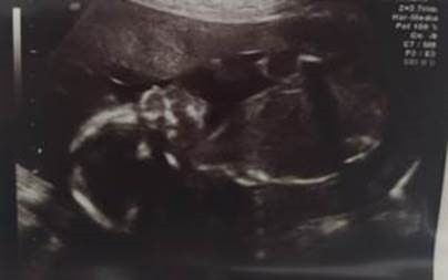 Ayuda con método ramzi: niño o niña? 5