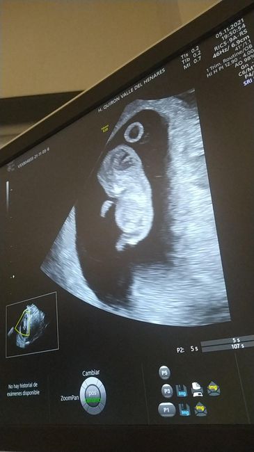 Ayuda con método ramzi: niño o niña? - 3