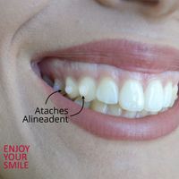 Brackets o invisilgn? - 2