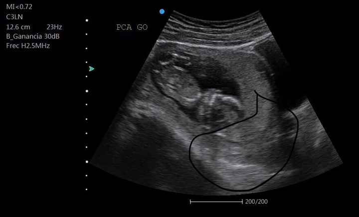 Supuestamente ahí está la placenta, según mi doctora