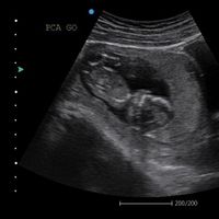 Ayuda! 12.6 semanas... yo creo que es niña 