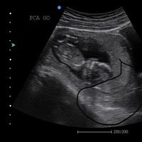 Supuestamente ahí está la placenta, según mi doctora