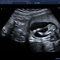 Ayuda con método ramzi: niño o niña? - 1