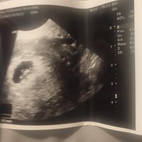 Ayuda con método ramzi: niño o niña? - 1