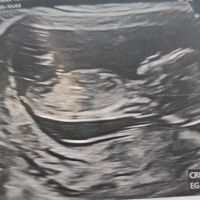Ayuda con método ramzi: niño o niña? - 1