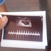 Ayuda con método ramzi: niño o niña? - 1