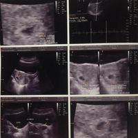 Ayuda con método ramzi: niño o niña? - 1