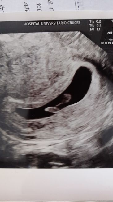 Ayuda con método ramzi: niño o niña? - 1