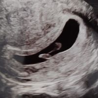 Ayuda con método ramzi: niño o niña? - 1