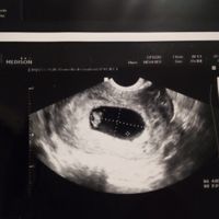 Ayuda con método ramzi: niño o niña? - 1