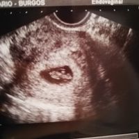 Ayuda con método ramzi: niño o niña? - 1
