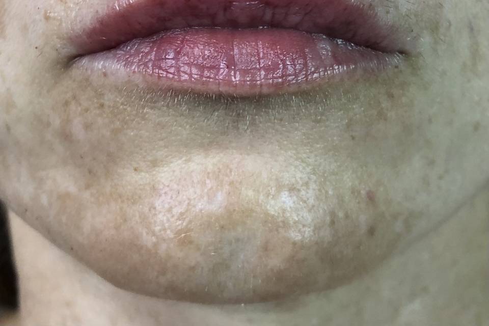 Relleno de labios